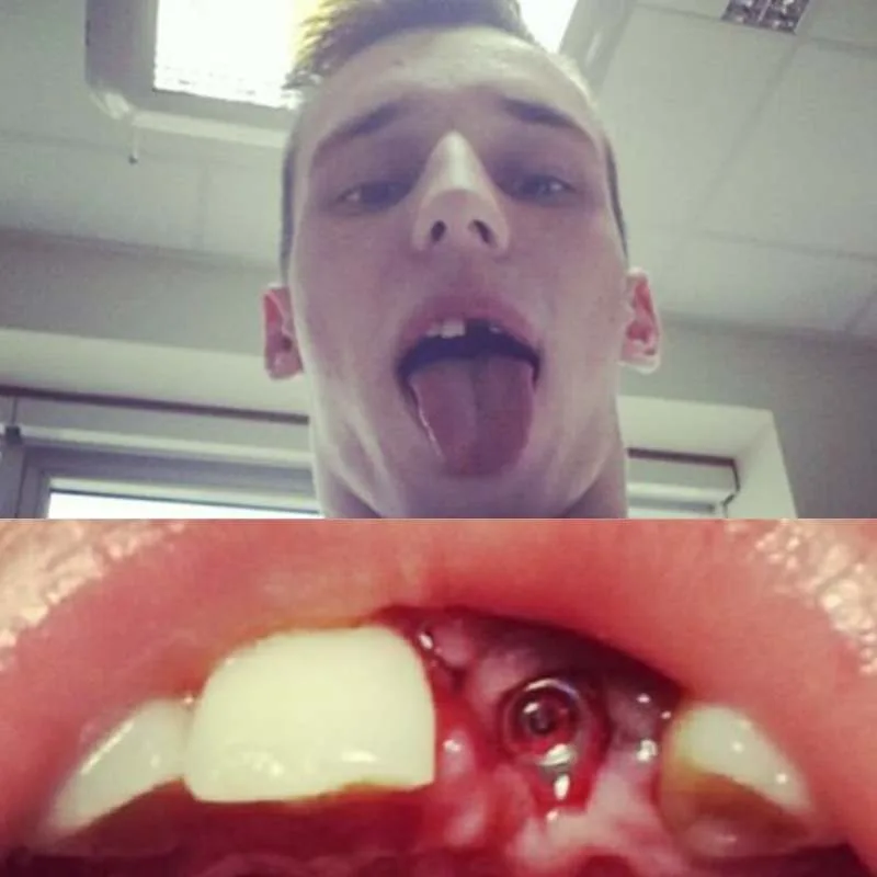 mouthguard for jiu-jitsu